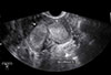 Pelvic Ultrasound